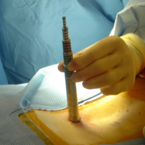 Key Hole Spine Surgery