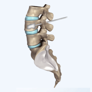 Kyphoplasty