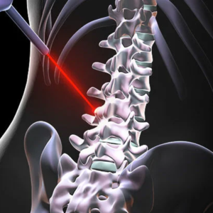 Laser Spine Surgery