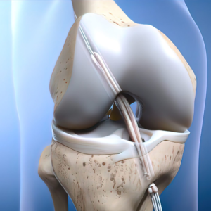 ACL Reconstruction orthospineandphysiorehab mumbai