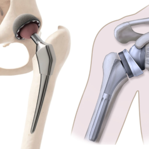 Shoulder Replacement and Hip Replacement orthospineandphysiorehab mumbai