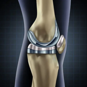 TOTAL knee replacement orthospineandphysiorehab mumbai